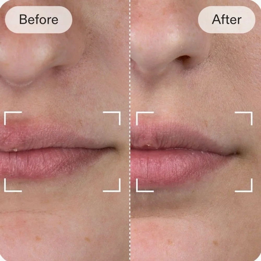 CURRENTBODY skin LED Lip Perfector Anti-aging LED wearable for youthful lips*NWB - Picture 5 of 6